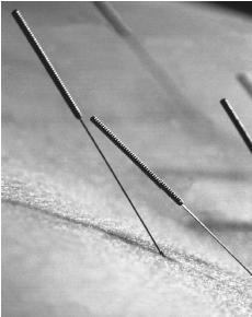 The purpose of acupuncture is to rebalance opposing energy forces in different parts of the body. In the United States, acupuncture is most widely used to treat pain associated with musculoskeletal disorders, but it has also been used in the treatment of substance abuse, and to relieve nausea and vomiting.  (Photo Researchers, Inc. Reproduced by permission.)