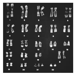 An accident or mutation in genetic development may cause retardation. An example of such a mutation is the development of an extra chromosome 21 that causes Down syndrome. Shown here is a chart (karyotype) showing the 22 chromosome pairs, and in pair 21, three chromosomes (instead of two) are shown. (Phototake/NYC. Reproduced by permission.) See color insert for color version of photo.